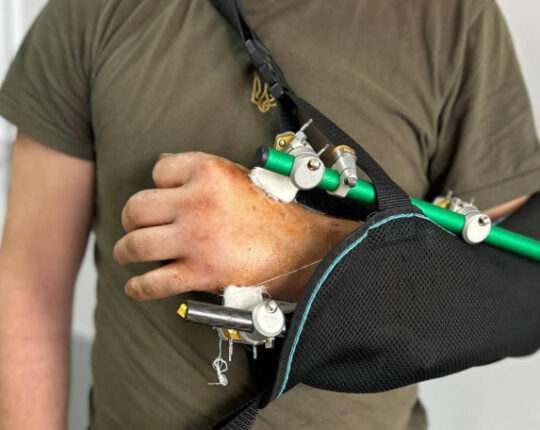 На Львівщині лікарі врятували руку чоловіку, яку він відрізав бензопилою