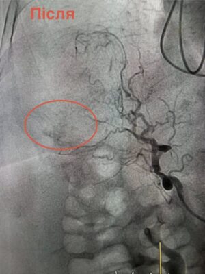 У Львові лікарі втретє врятували життя пацієнтці за допомогою ендоваскулярного втручання