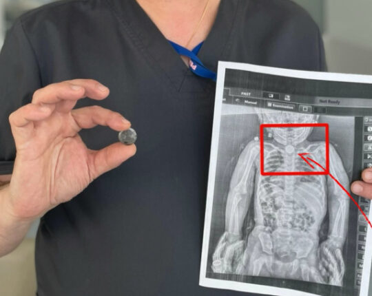 Львівські хірурги витягли зі стравоходу дівчинки батарейку