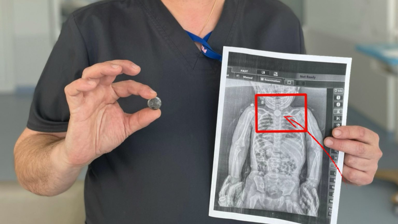 Львівські хірурги витягли зі стравоходу дівчинки батарейку