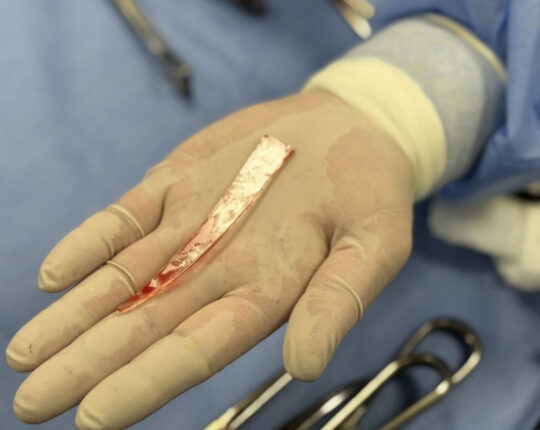 Львівські лікарі дістали із легені пацієнта 10-сантиметровий уламок
