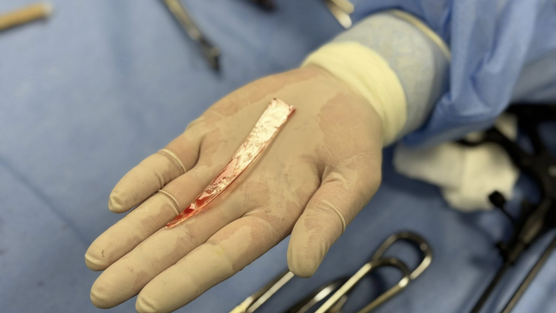 Львівські лікарі дістали із легені пацієнта 10-сантиметровий уламок