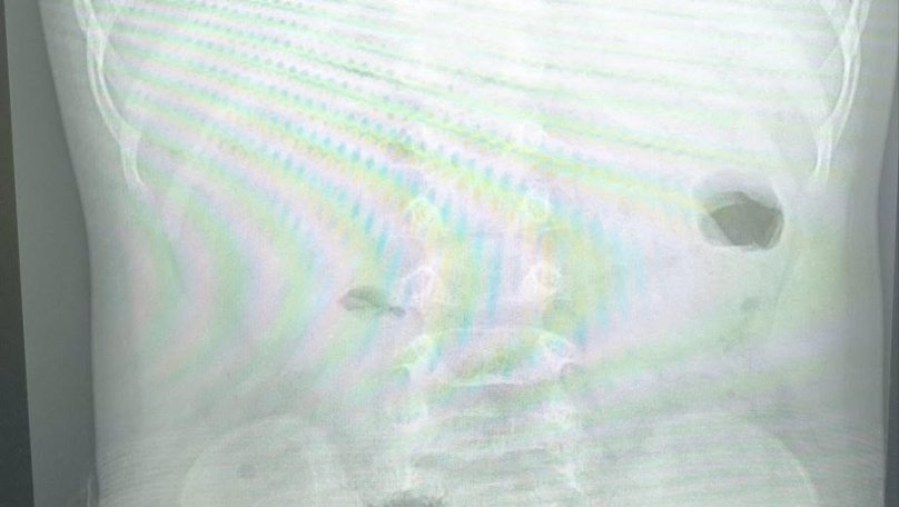Львівські лікарі півтори години діставали арахіс із легені дитини